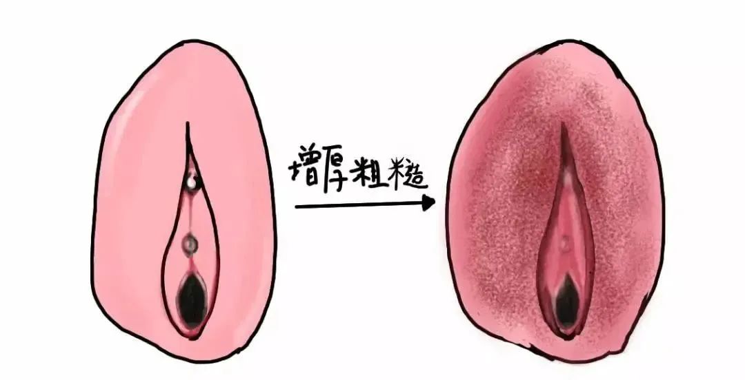外阴白斑初期四种最明显的症状 外阴白斑初期四种最明显的症状