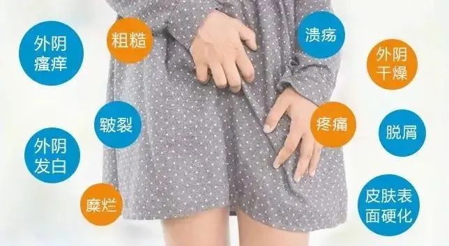 外阴白斑患者该怎么护理? 外阴白斑患者该怎么护理?