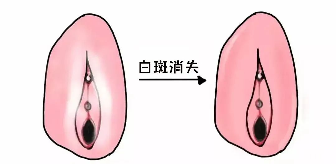 外阴白斑好转的迹象有哪些? 外阴白斑好转的迹象有哪些?