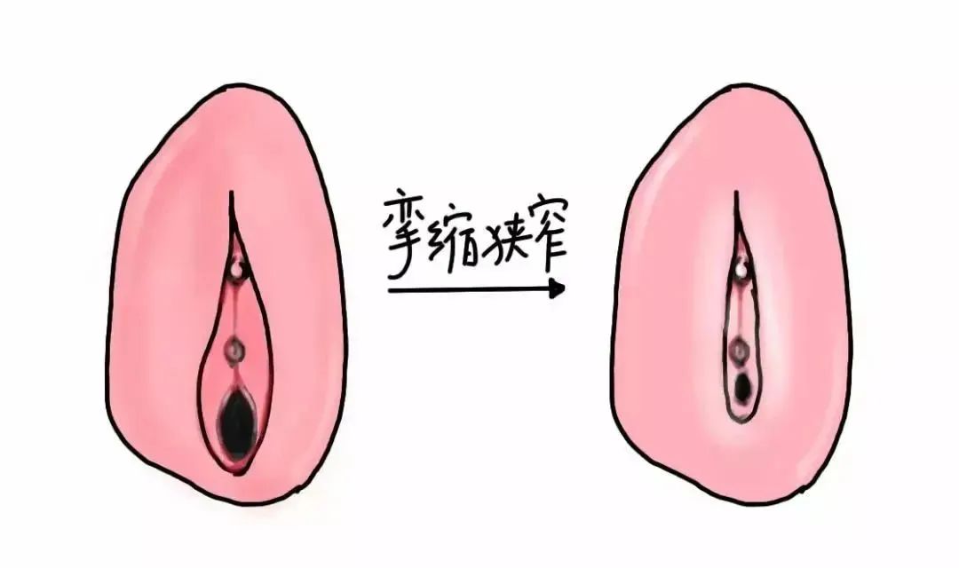 外阴白斑初期四种最明显的症状 外阴白斑初期四种最明显的症状