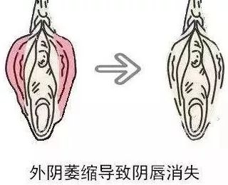 维生素E软膏可以用于外阴白斑吗? 维生素E软膏可以用于外阴白斑吗?