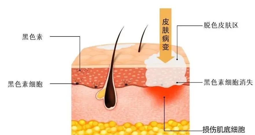 如何帮助外阴白斑小患者走出自己的心里困境? 如何帮助外阴白斑小患者走出自己的心里困境?