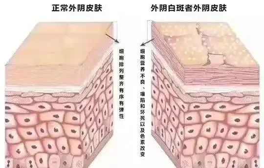 为什么外阴白斑难治疗 为什么外阴白斑难治疗