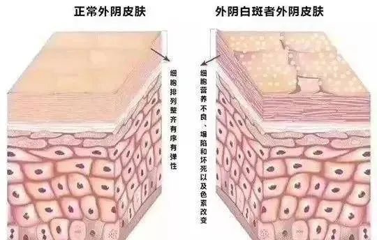 得了外阴白斑二十几年还能治疗好吗? 得了外阴白斑二十几年还能治疗好吗?