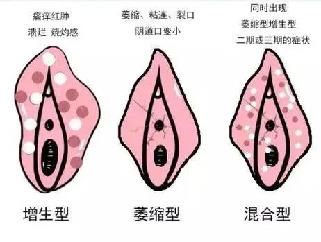外阴白斑的早期症状都有哪些? 外阴白斑的早期症状都有哪些?