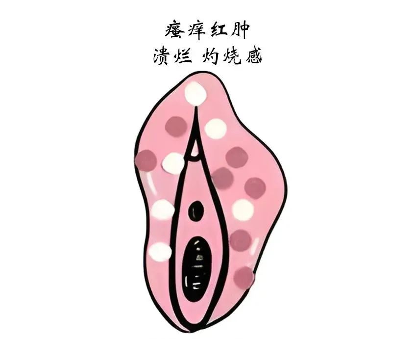 患上外阴白斑后有什么症状表现