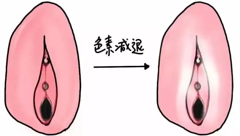 外阴白斑会因为哪些因素加快扩散? 外阴白斑会因为哪些因素加快扩散?