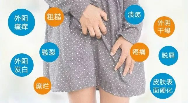 外阴白斑有哪些症状 外阴白斑有哪些症状