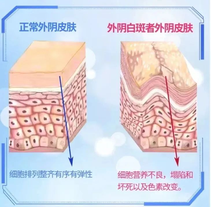 微循环又是如何导致外阴白斑疾病的? 微循环又是如何导致外阴白斑疾病的?