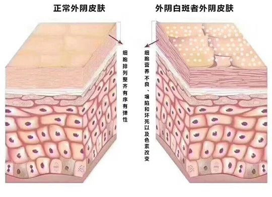 外阴白斑好转的迹象都有哪些? 外阴白斑好转的迹象都有哪些?