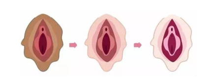 外阴白斑会传染吗? 外阴白斑会传染吗?